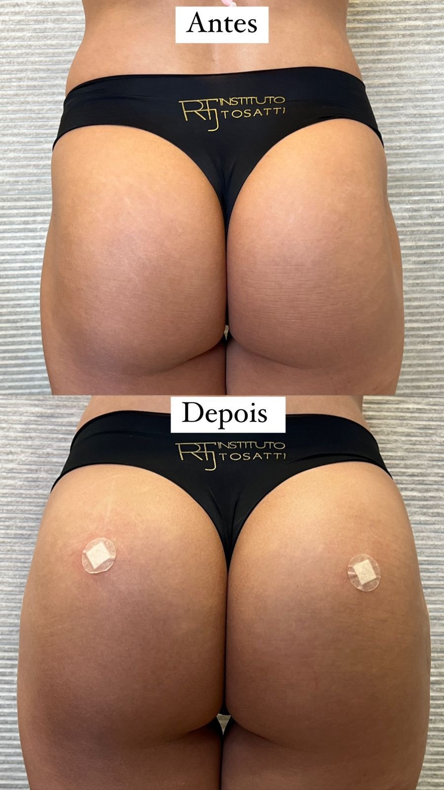 Antes e depois de remodelação glútea em vista posterior